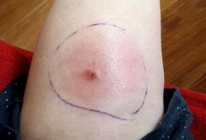 A horsefly bite on skin with redness surrounding the area