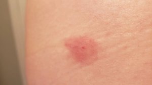 A horsefly bite on pale skin